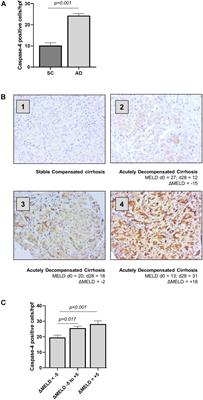 The Lipopolysaccharide-Sensing Caspase(s)-4/11 Are Activated in Cirrhosis and Are Causally Associated With Progression to Multi-Organ Injury